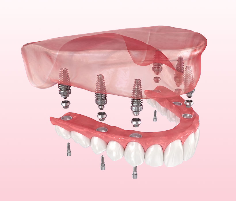 All-on-4 All-on-6 implants