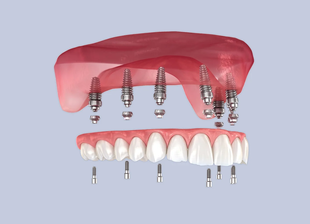 All-on-4 and All-on-6 full-arch dental implant treatment