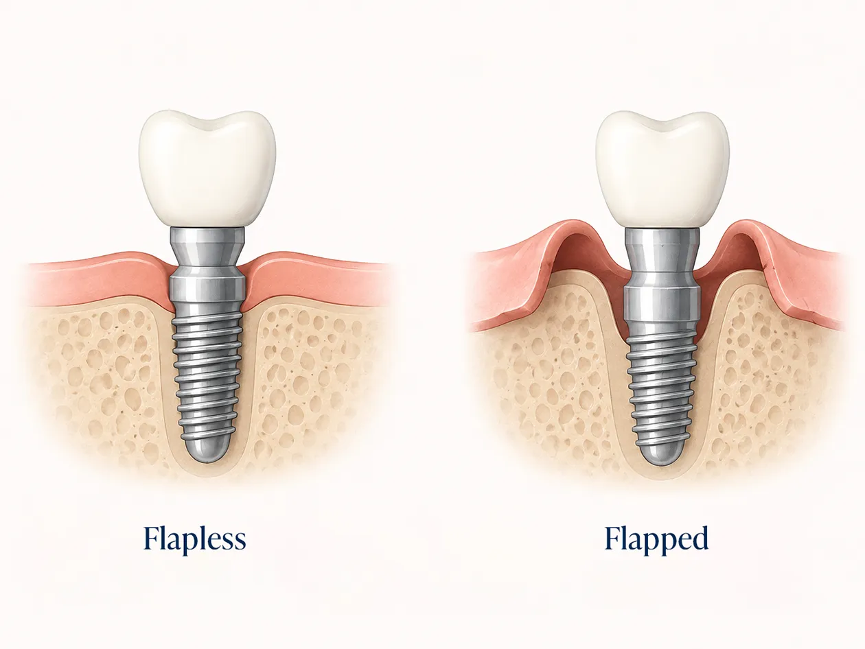 Comparison of flapless and conventional implant surgery